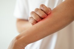 Understanding Red, Itchy Skin: Differentiating Between Allergy and Eczema